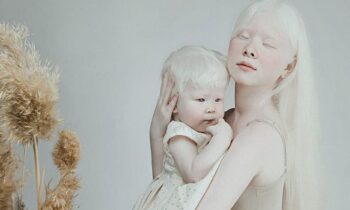 Veja esse incrível ensaio que mostra a beleza de irmãs albinas