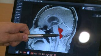 Homem viveu durante anos com dores de cabeça e tinha algo vivendo lá dentro