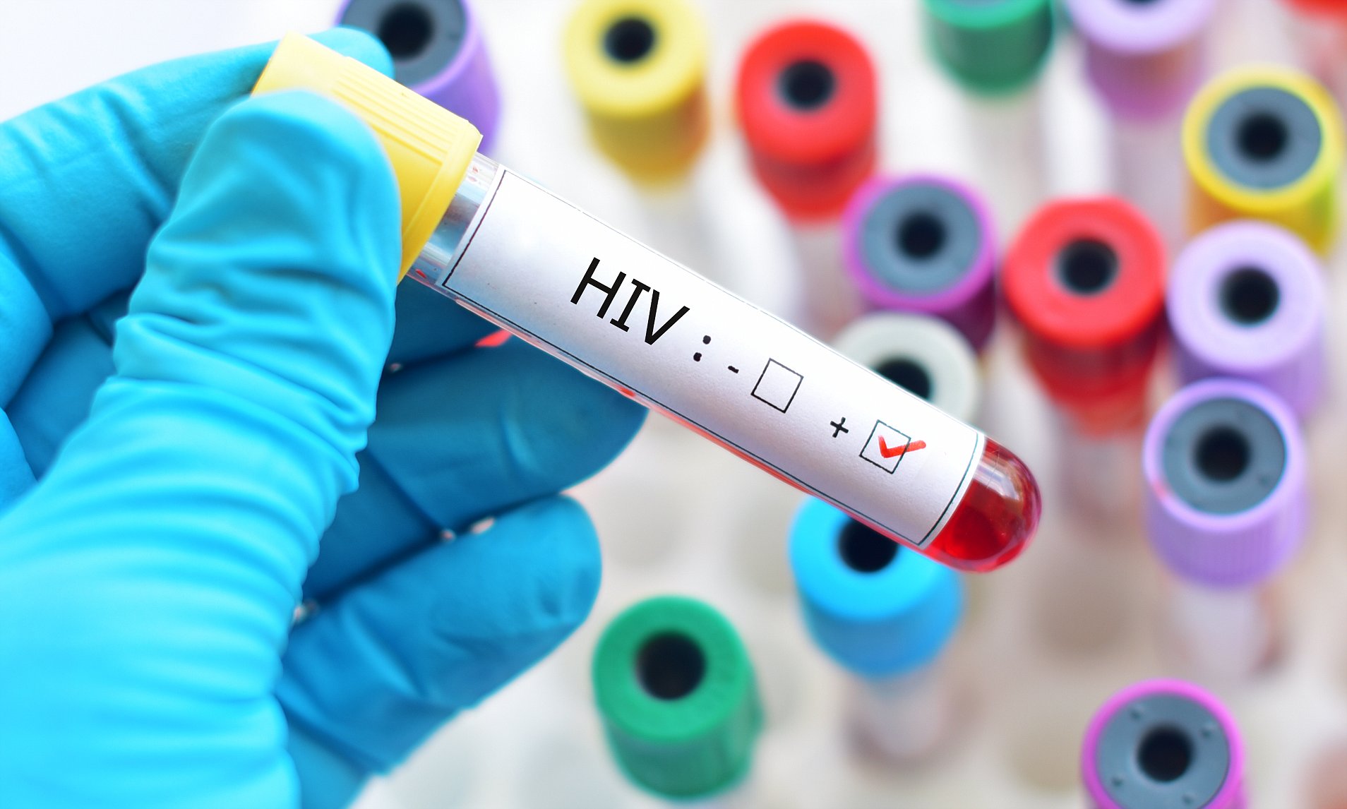 Medicina brasileira pode finalmente ter encontrado a cura do HIV
