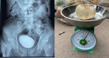 Médicos retiram pedra de 400 gramas da bexiga de uma vietnamita