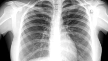Mulher com suspeita de tuberculose estava com camisinha no pulmão