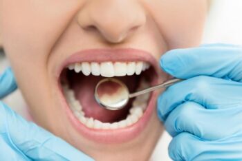 Tratamento dentário pode curar cáries sem nenhuma obturação