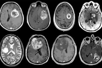Esse protótipo de capacete magnético encolheu câncer cerebral agressivo