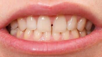 Por que alguns dentes separam mesmo depois de usar aparelho?