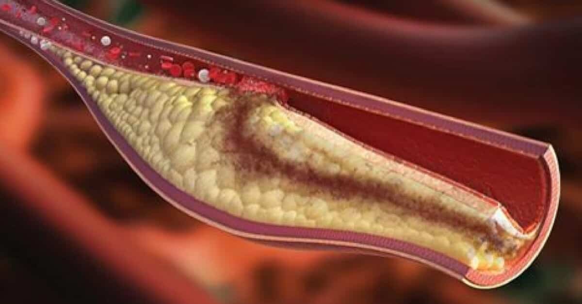Injeção de ''silenciamento de genes'' foi aprovada para tratar colesterol alto