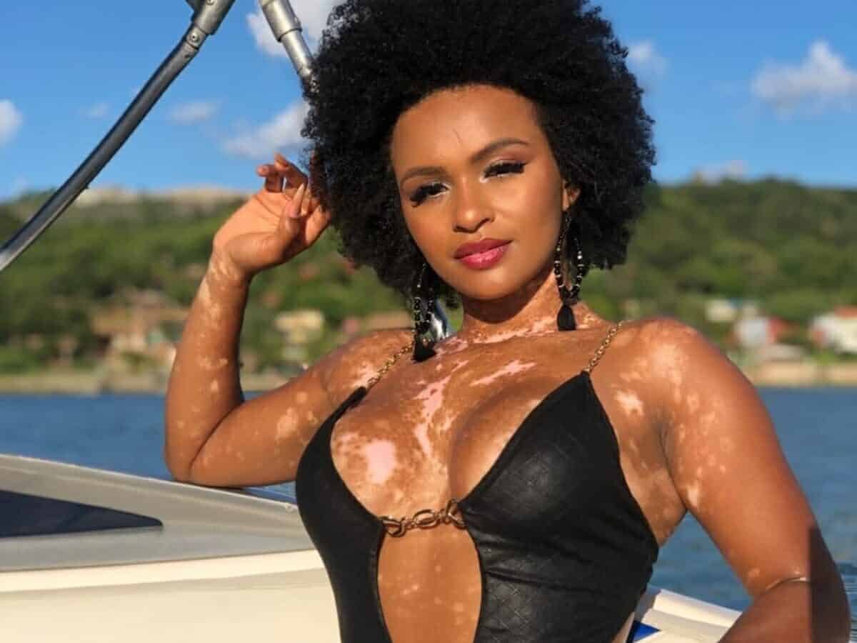 O que é vitiligo? A doença de pele da participante Natália, do BBB