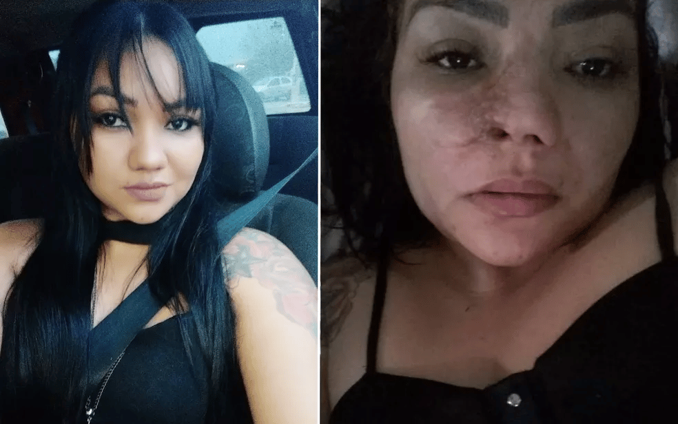 Mulher denuncia que perdeu parte do nariz após cirurgia estética com dentista