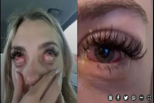 Jovem quase fica cega após fazer extensão de cílios