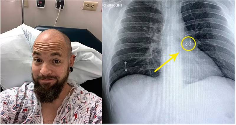 Homem vai ao hospital com tosse e descobre piercing alojado no pulmão