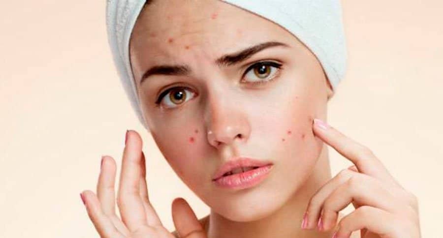 Tratamento revolucionário para acne é liberado por ”Anvisa” americana