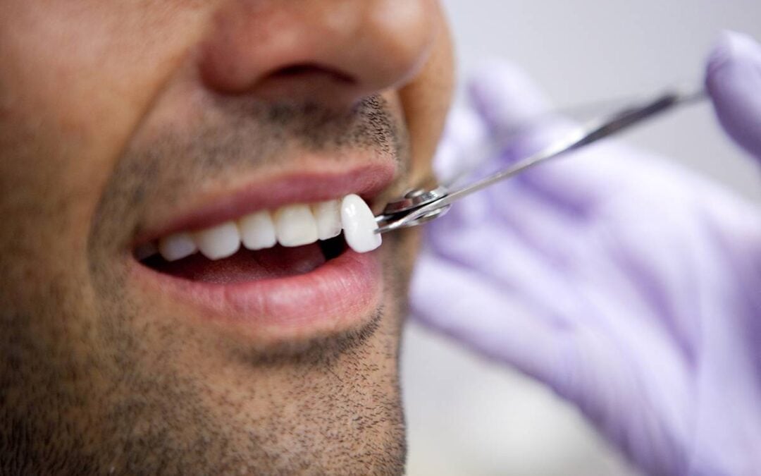 Veja os riscos das lentes de contato nos dentes que viraram moda