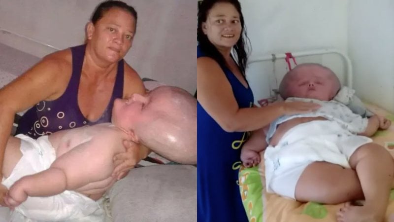Brasileira com hidrocefalia, com expectativa de 3 meses de vida, faz 29 anos