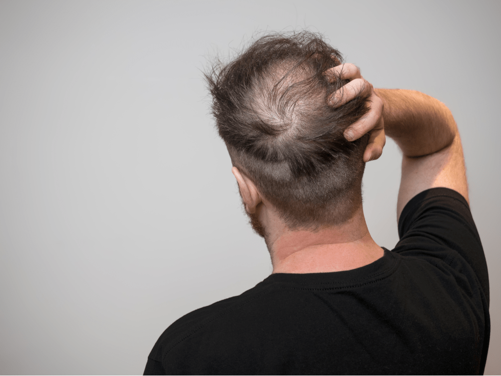 Calvície na moda! Corte de cabelo calvão de cria viraliza nas