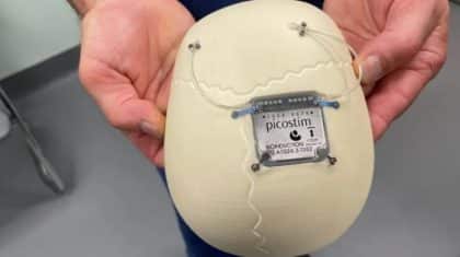 Criança recebe 1º implante cerebral para epilepsia do mundo