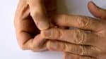 Homem percebe mudança nas unhas e descobre câncer de pulmão