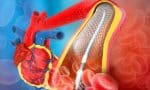 Hospital brasileiro testa tratamento com ondas de choque para desobstruir artérias sem uso de stent
